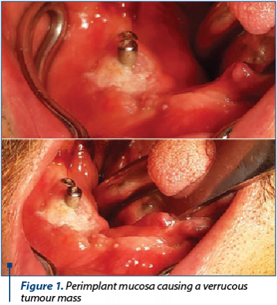 Figure 1. Perimplant mucosa causing a verrucous tumour mass 