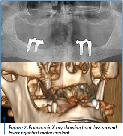 Figure 2. Panoramic X-ray showing bone loss around lower right first molar implant
