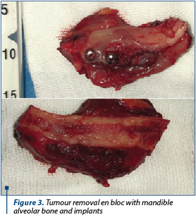 Figure 3. Tumour removal en bloc with mandible alveolar bone and implants 