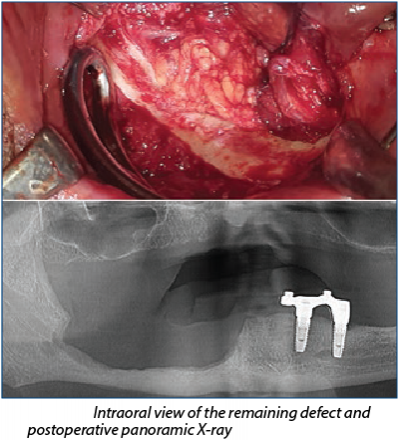 Figure 4. Intraoral view of the remaining defect and postoperative panoramic X-ray 