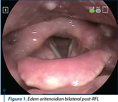 Figura 1. Edem aritenoidian bilateral post-RFL