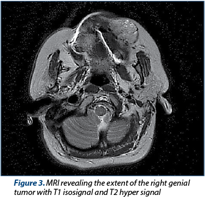 Figure 3. MRI revealing the extent of the right genial tumor with T1 isosignal and T2 hyper signal 