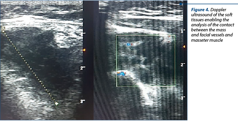 Figure 4. Doppler ultrasound of the soft tissues ena­bling the analysis of the contact between the mass and facial vessels and masseter muscle
