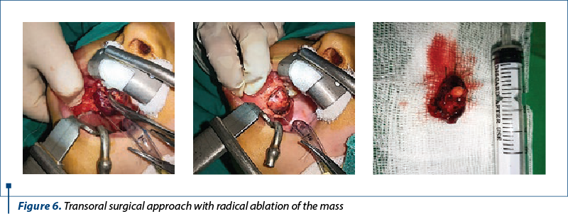 Figure 6. Transoral surgical approach with radical ablation of the mass