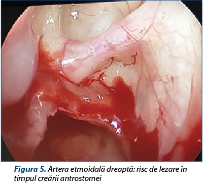 Figura 5. Artera etmoidală dreaptă: risc de lezare în timpul creării antrostomei