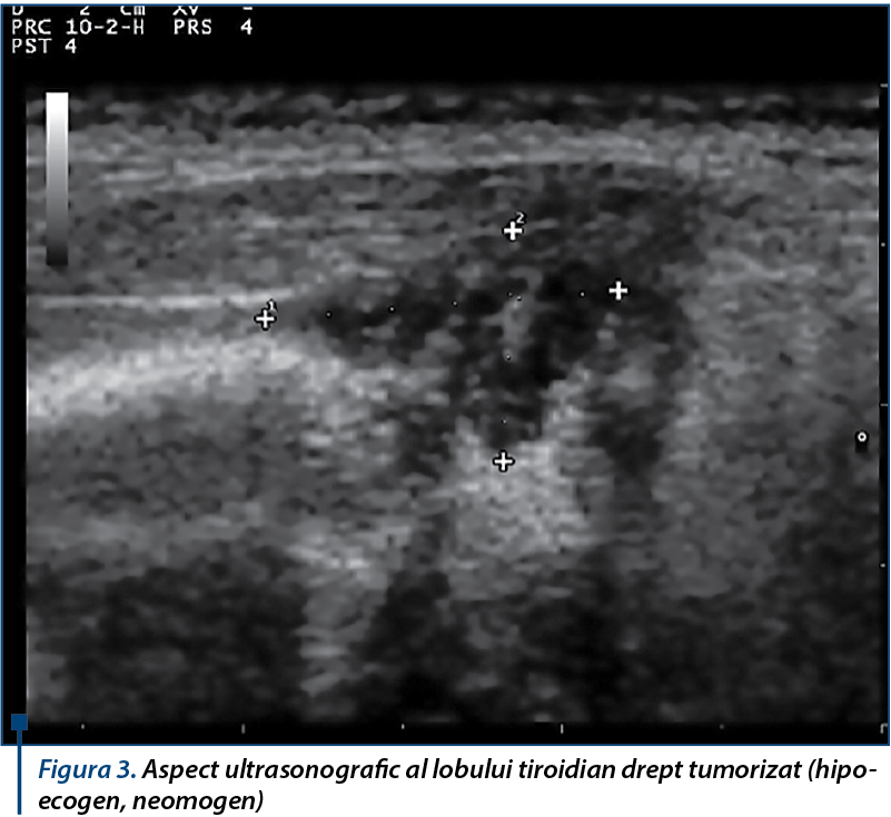 Aspect ultrasonografic al lobului tiroidian drept tumorizat 