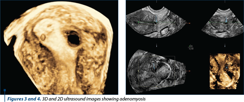 Figures 3 and 4. 3D and 2D ultrasound images showing adenomyosis