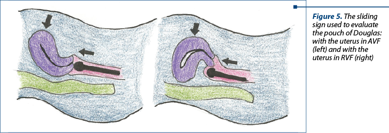 Figure 5. The sliding sign used to evaluate the pouch of Douglas: with the uterus in AVF (left) and with the uterus in RVF (right)