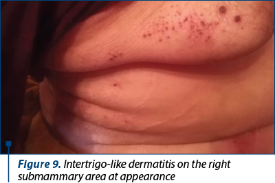 Figure 9. Intertrigo-like dermatitis on the right submammary area at appearance