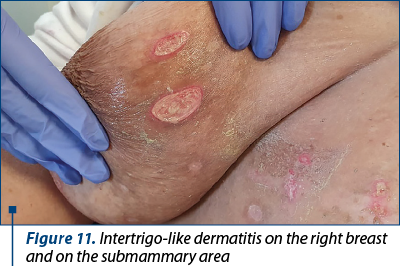 Figure 11. Intertrigo-like dermatitis on the right breast and on the submammary area