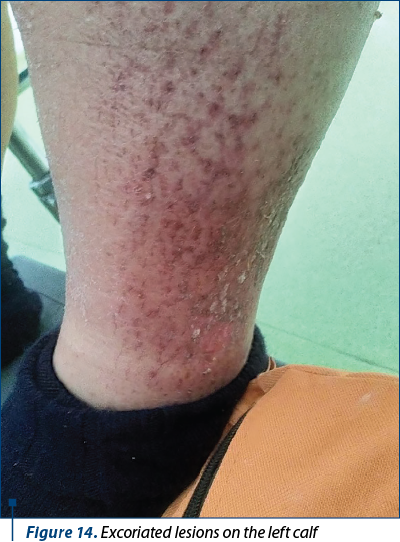 Figure 14. Excoriated lesions on the left calf