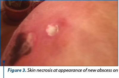 Figure 3. Skin necrosis at appearance of new abscess on left buttock (Nicolau syndrome)
