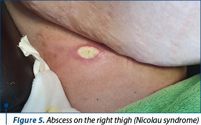 Figure 5. Abscess on the right thigh (Nicolau syndrome)