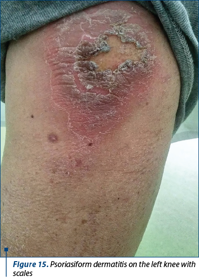 Figure 15. Psoriasiform dermatitis on the left knee with scales