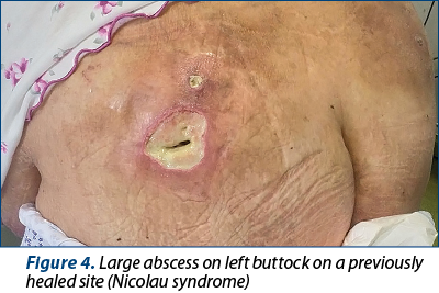 Figure 4. Large abscess on left buttock on a previously healed site (Nicolau syndrome)