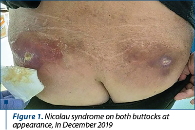Figure 1. Nicolau syndrome on both buttocks at appearance, in December 2019