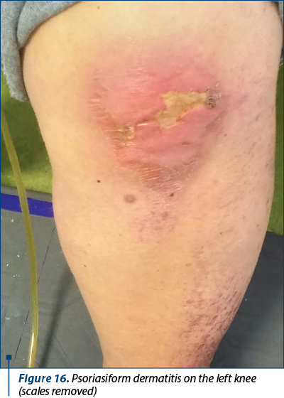 Figure 16. Psoriasiform dermatitis on the left knee (scales removed)