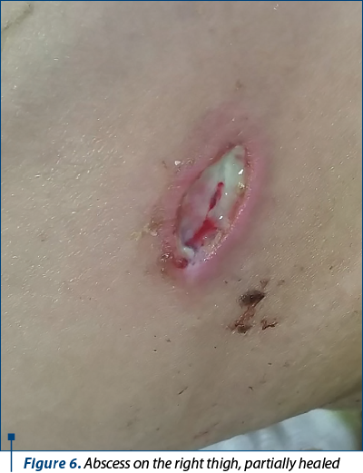Figure 6. Abscess on the right thigh, partially healed
