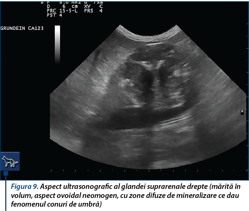 Aspect ultrasonografic al glandei suprarenale drepte 