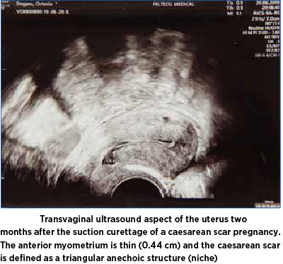 Figure 5. Transvaginal ultrasound aspect of the uterus two months after the suction curettage of a caesarean scar pregnancy. The anterior myometrium is thin (0.44 cm) and the caesarean scar is defined as a triangular anechoic structure (niche)