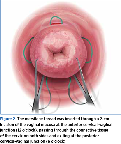 Figure 2. The mersilene thread was inserted through a 2-cm  incision of the vaginal mucosa at the anterior cervical-vaginal junction (12 o’clock), passing through the connective tissue  of the cervix on both sides and exiting at the posterior  cervical-vaginal junction (6 o’clock)