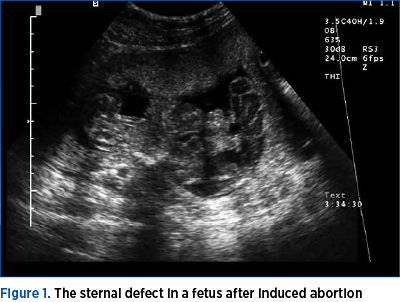 Figure 1. The sternal defect in a fetus after induced abortion