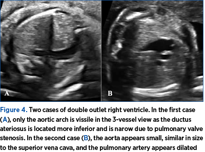 Figure 4. Two cases of double outlet right ventricle. In the first case (A), only the aortic arch is vissile in the 3-vessel view as the ductus ate­rio­sus is located more inferior and is narow due to pulmonary valve ste­no­sis. In the second case (B), the aorta appears small, similar in size to the superior vena cava, and the pulmonary artery appears dilated