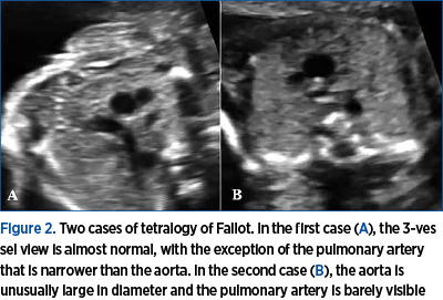Figure 2. Two cases of tetralogy of Fallot. In the first case (A), the 3-vessel view is almost normal, with the exception of the pulmonary artery that is narrower than the aorta. In the second case (B), the aorta is unusually large in diameter and the pulmonary artery is barely visible 