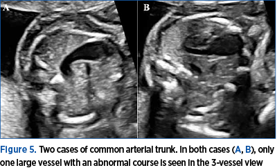 Figure 5. Two cases of common arterial trunk. In both cases (A, B), only one large vessel with an abnormal course is seen in the 3-vessel view
