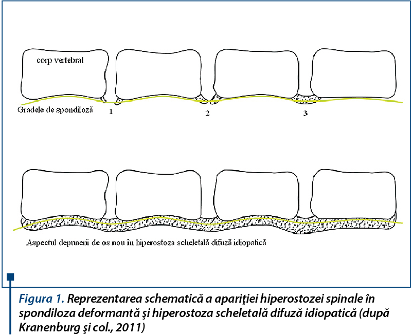 Reprezentarea schematică a apariţiei hiperostozei spinale în spondiloza deformantă şi hiperostoza 