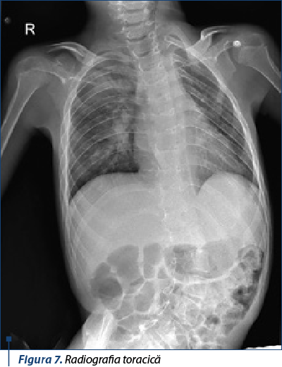 Figura 7. Radiografia toracică