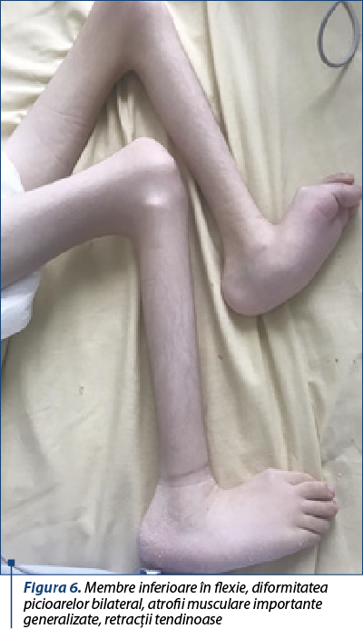 Figura 6. Membre inferioare în flexie, diformitatea picioarelor bilateral, atrofii musculare importante generalizate, retracţii tendinoase