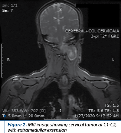 Figure 2. MRI image showing cervical tumor at C1-C2, with extramedullar extension 