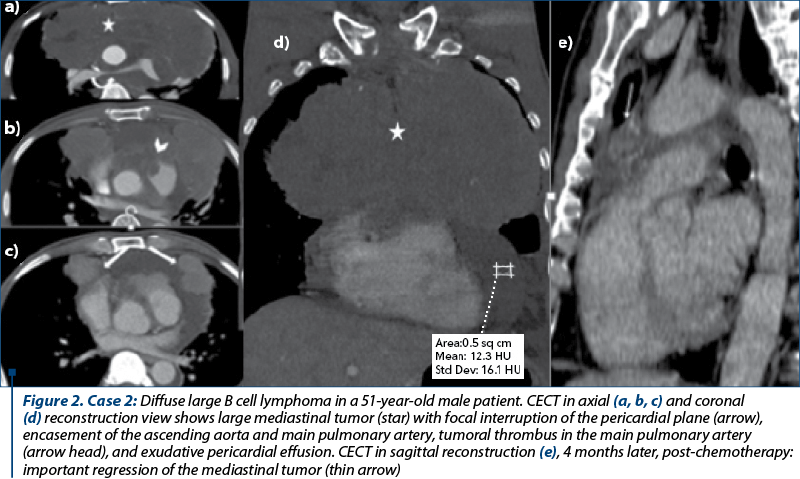 Figure 2. Case 2: Diffuse large B cell lymphoma in a 51-year-old male patient. CECT in axial (a, b, c) and coronal (d) reconstruction view shows large mediastinal tumor (star) with focal interruption of the pericardial plane (arrow), encasement of the ascending aorta and main pulmonary artery, tumoral thrombus in the main pulmonary artery (arrow head), and exudative pericardial effusion. CECT in sagittal reconstruction (e), 4 months later, post-chemotherapy: important regression of the mediastinal tumor (thin arrow)
