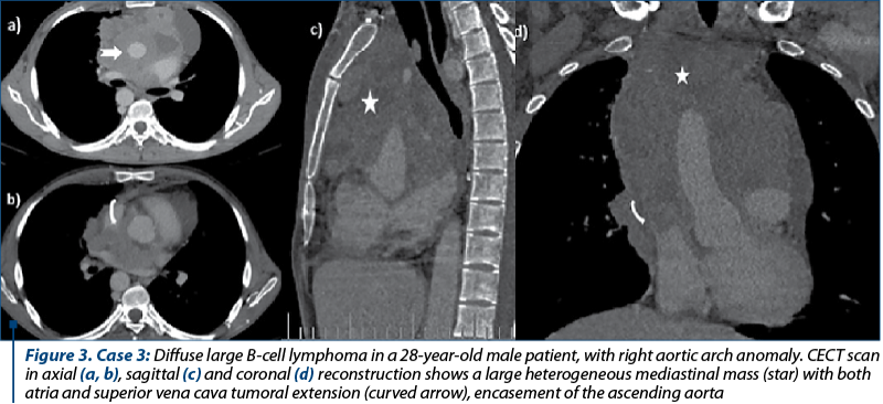 Figure 3. Case 3: Diffuse large B-cell lymphoma in a 28-year-old male patient, with right aortic arch anomaly. CECT scan in axial (a, b), sagittal (c) and coronal (d) reconstruction shows a large heterogeneous mediastinal mass (star) with both atria and superior vena cava tumoral extension (curved arrow), encasement of the ascending aorta