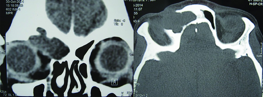 Figura 2. CT cranio-cerebral - liza plafonului orbitar drept  şi discontinuităţi osoase  la nivelul peretelui posterior  al sinusului frontal drept