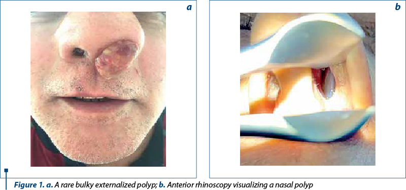 Figure 1. a. A rare bulky externalized polyp; b. Anterior rhinoscopy visualizing a nasal polyp