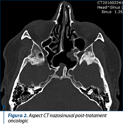 Figura 2. Aspect CT nazosinusal post-tratament oncologic