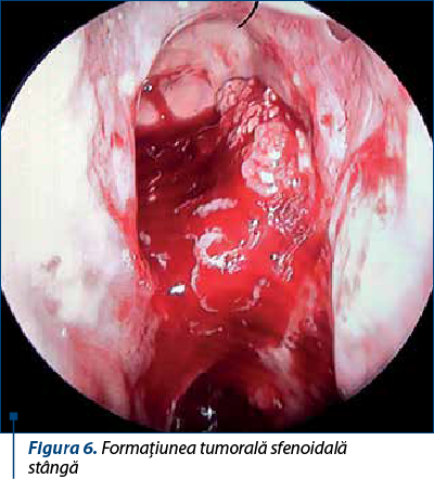 Figura 6. Formaţiunea tumorală sfenoidală  stângă