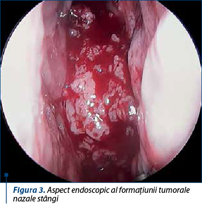 Figura 3. Aspect endoscopic al formaţiunii tumorale nazale stângi