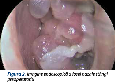 Figura 2. Imagine endoscopică a fosei nazale stângi  preoperatoriu