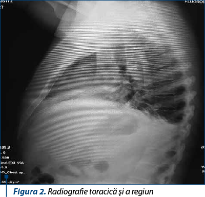 Figura 2. Radiografie toracică şi a regiunii cervicale