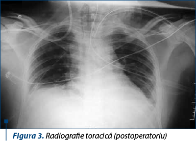 Figura 3. Radiografie toracică (postoperatoriu)