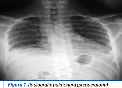 Figura 1. Radiografie pulmonară (preoperatoriu)