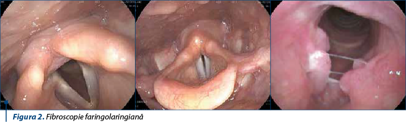 Figura 2. Fibroscopie faringolaringiană