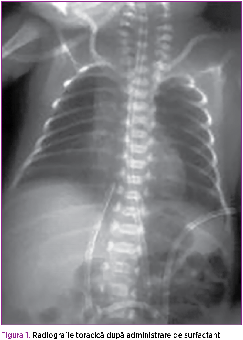 Figura 1. Radiografie toracică după administrare de surfactant