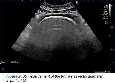 Figure 2. US measurement of the transverse rectal diameter  in patient 10
