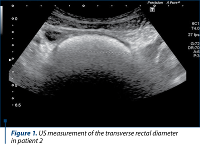Figure 1. US measurement of the transverse rectal diameter  in patient 2