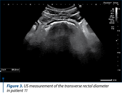 Figure 3. US measurement of the transverse rectal diameter  in patient 11