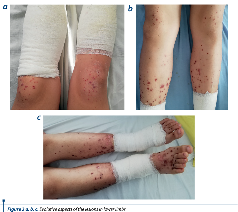 Figure 3 a, b, c. Evolutive aspects of the lesions in lower limbs